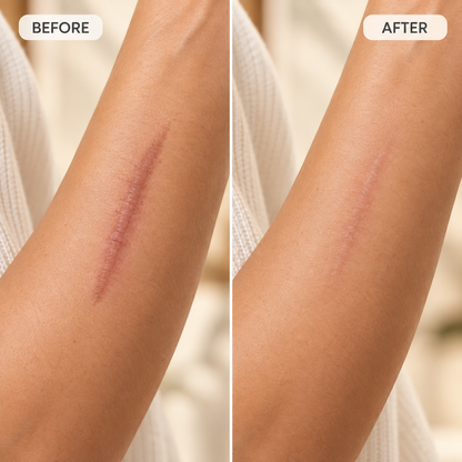 Scar Removal Cream