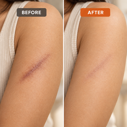 Scar Removal Cream