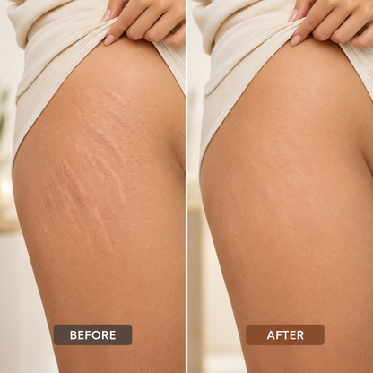 Scar Removal Cream